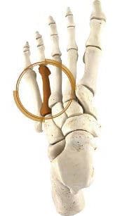 Brachymetatarsia Surgery