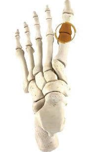 Hallux Rigidus