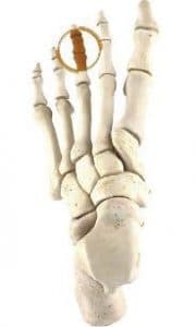 Hammertoe Surgery Perth - Foot Surgeon Perth - Perth Podiatric Surgery