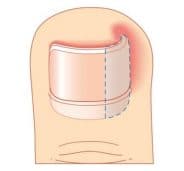 Ingrown Toenail Surgery