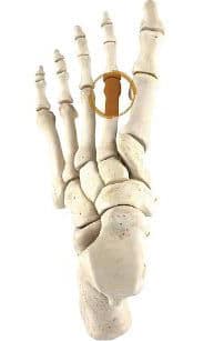 Metatarsalgia Surgery
