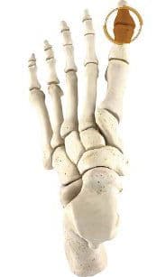 Subungual Exostosis Surgery