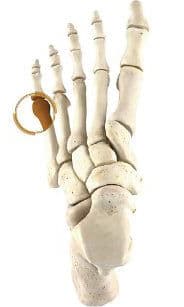 Tailor’s Bunion Surgery