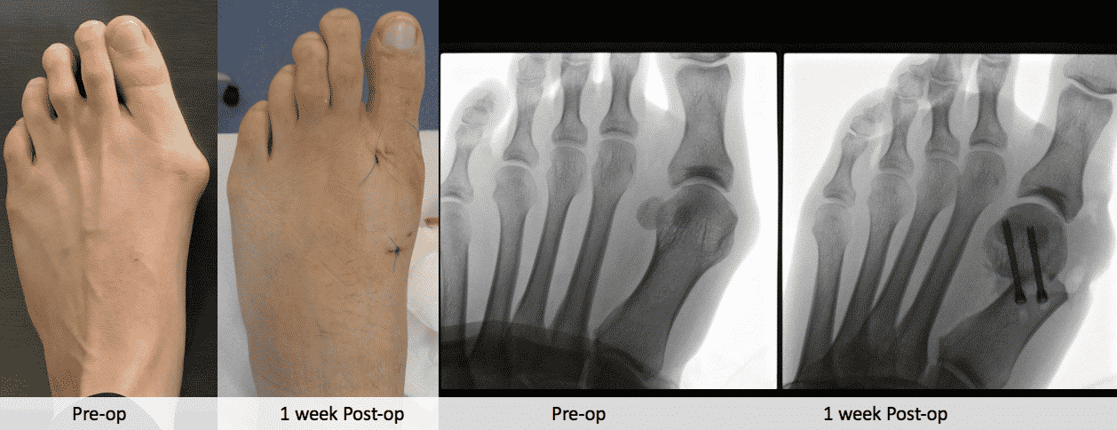 bunionectomy x ray