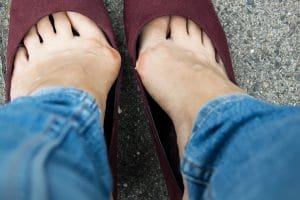 Keyhole Bunion Surgery in Perth by Dr Andrew Knox - Perth Podiatric Surgery
