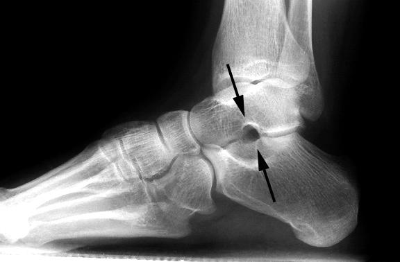 HyProCare Flat Foot Surgery Perth X-Ray