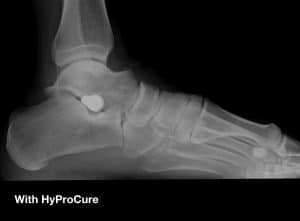 HyProCure Foot Surgery Perth