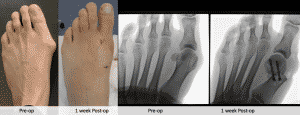 keyhole bunion surgery perth