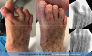 hammertoe surgery perth