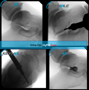 hyprocure procedure
