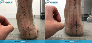 hyprocure procedure