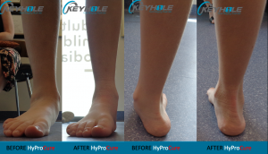 hyprocure procedure