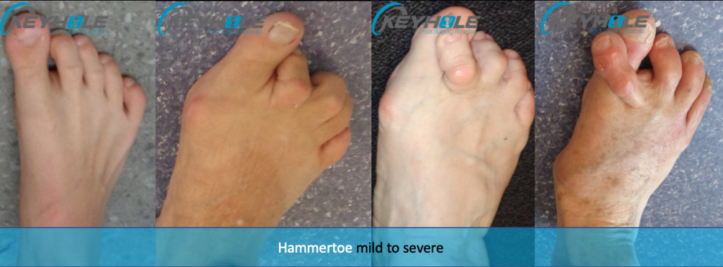 Minimally Invasive Hammertoe Surgery Perth | Perth Podiatric Surgery