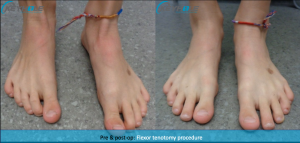hammertoe surgery perth