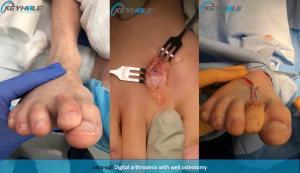 hammertoe surgery perth