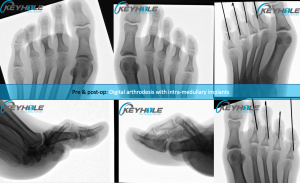 hammertoe surgery perth