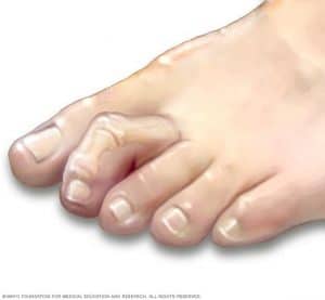 minimally invasive hammertoe surgery perth