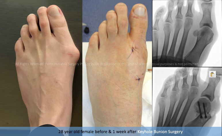 Minimally Invasive Bunion Surgery Perth Podiatric Surgery