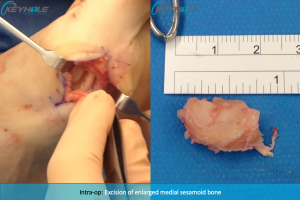 sesamoid bone surgery perth