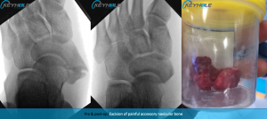 accessory navicular bone perth