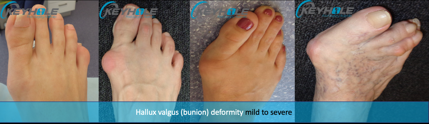 Minimally Invasive Bunion Surgery Perth Perth Podiatric Surgery