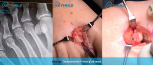frieberg's disease perth