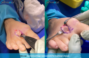 frieberg's disease perth