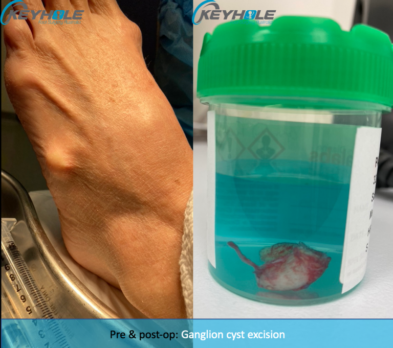Ganglion Cysts Perth Podiatric Surgery