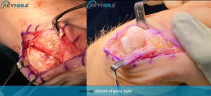gout removal surgery perth