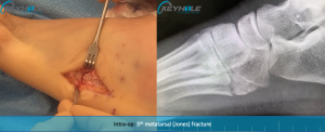 jones fracture repair perth
