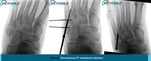 jones fracture repair perth