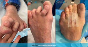 plantar plate repair perth