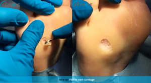 plantar wart surgery perth