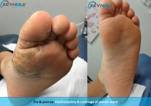 plantar wart surgery perth