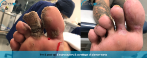 plantar wart surgery perth