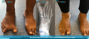 revisional foot surgery perth