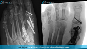 revisional foot surgery perth