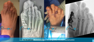 revisional foot surgery perth