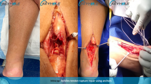 achilles tendon rupture repair