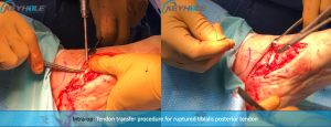 flexor digitorum longus transfer