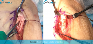 tibialis anterior tendon tear