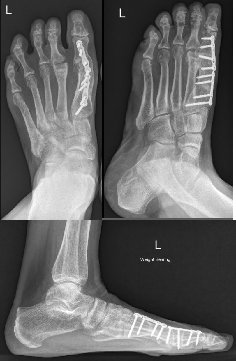 Revisional Foot Surgery - Perth Podiatric Surgery